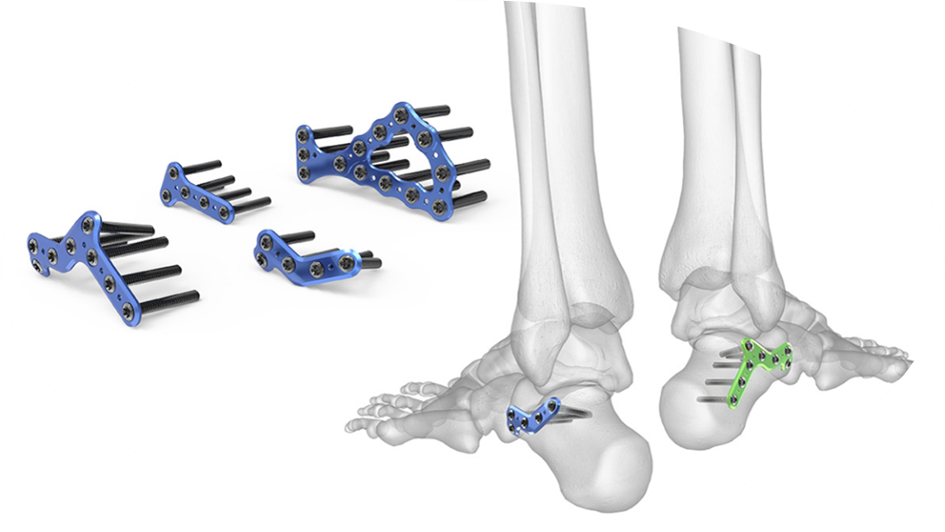 ロッキングカルカニアルプレーティングシステム | 製品情報 | エム