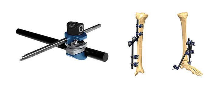 GALAXY創外固定器 | 製品情報 | エム・シー・メディカル株式会社